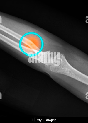 Ellenbogen Röntgen eines 4 Jahre alten Mädchens, ihrem proximalen Radius und Ulna gebrochen Stockfoto