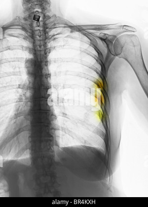 x-ray zeigt Rippenfrakturen in eine 53 jährige Frau Stockfoto