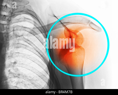 x-ray zeigt eine Schulterluxation in ein 26 Jahre alter Mann Stockfoto