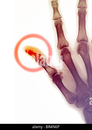 Hand Röntgen einen 68 Jahre alten Mannes, der seine Daumenspitzen gebrochen Stockfoto