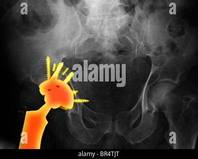 x-ray zeigt ein künstliches Hüftgelenk in ein 56 Jahre alter Mann Stockfoto