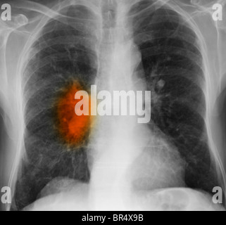 x-ray zeigt Lungenkrebs in einem 80 Jahre alten Mann mit einer langen Geschichte des Rauchens Stockfoto