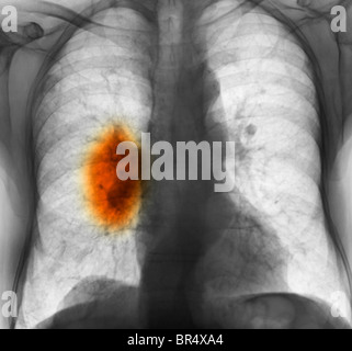x-ray zeigt Lungenkrebs in einem 80 Jahre alten Mann mit einer langen Geschichte des Rauchens Stockfoto