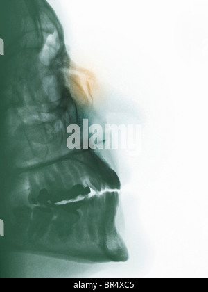 x-ray zeigt eine gebrochene Nase in eine Frau, die gefallen Stockfoto