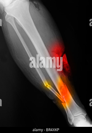 x-ray zeigt eine offenen schien- und Wadenbein Fraktur des Unterschenkels einen 65 Jahre alten Mann in einem Motorradunfall verwickelt Stockfoto