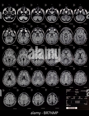 Gehirn MRT Magnetresonanztomographie oder NMRI kernmagnetische Resonanz-Bildgebung der Kinder- Stockfoto