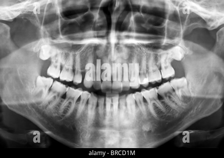 Dental-Scan x-ray ein 35 Jahre alter Mann. Stockfoto