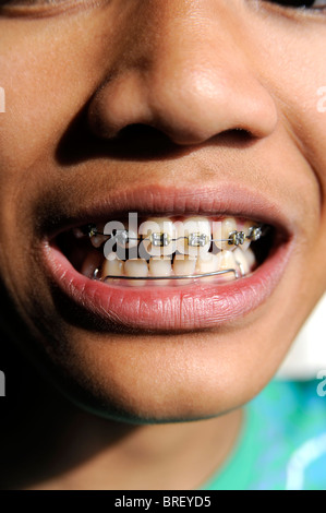Junge mit Kieferorthopädie Zahnspange, 12 Jahre alt Stockfoto
