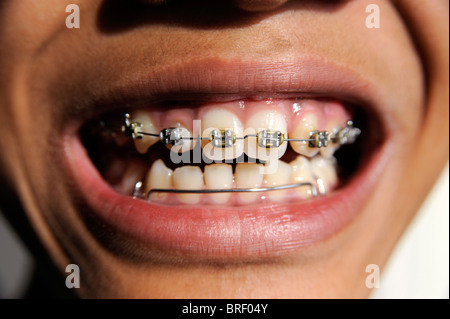 Junge mit Kieferorthopädie Zahnspange, 12 Jahre alt Stockfoto