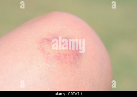 Geknickte Frau Knie Stockfoto