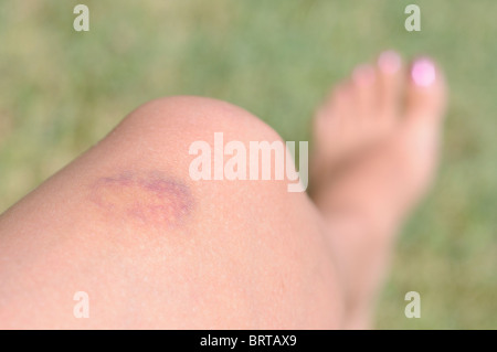 Geknickte Frau Knie Stockfoto