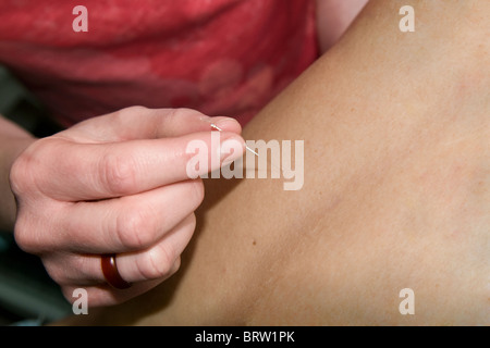Weibliche Akupunkteur Nadeln im Rücken Platzierung Punkte auf mans zurück Stockfoto