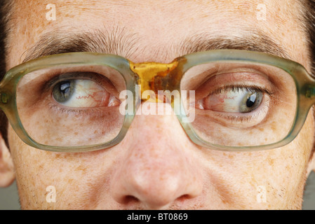 Eine Person leidet unter einer schweren Form von Strabismus - Auge closeup Stockfoto