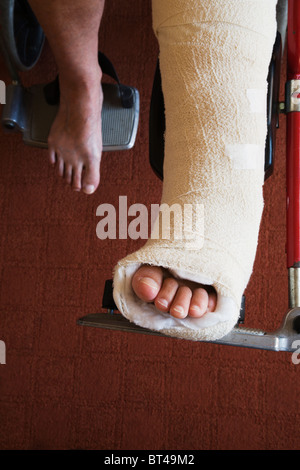 Eine Frau mit gebrochenen Knöchel Knochen gesetzt in einem Gipsverband "Zurück Platte". Stockfoto