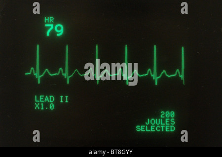 Bildschirm zeigt ein Patient Herzfrequenz-Messgerät in einer Krankenstation Stockfoto