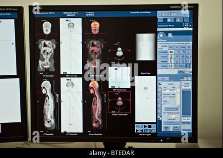 PET-CT Diagnostik medizinische Scanner Bilder auf Computer-Monitor, Nahaufnahme Stockfoto