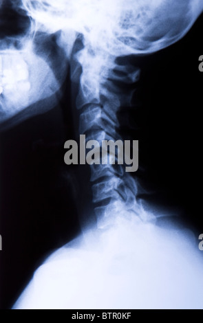 Seitenansicht eines Halses Röntgen Stockfoto