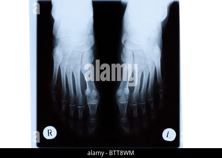 X-ray Reife Frau Füße. Stockfoto