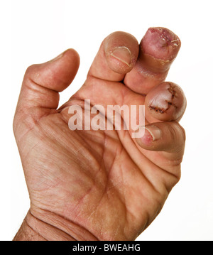 Männchen der linken Hand auf weißem Hintergrund fehlen zwei Finger hautnah Stockfoto