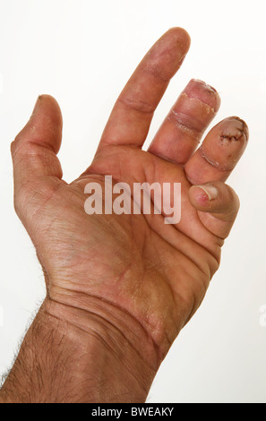 Männchen der linken Hand auf weißem Hintergrund fehlen zwei Finger hautnah Stockfoto