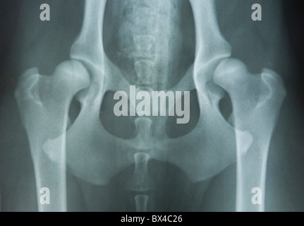 Röntgen der Hüfte Stockfotografie - Alamy