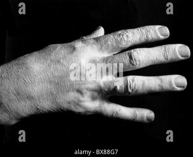 Liszt, Franz, 22.10.11.11, 31.7.6, ungarischer Komponist und Pianist, seine rechte Hand, Stockfoto