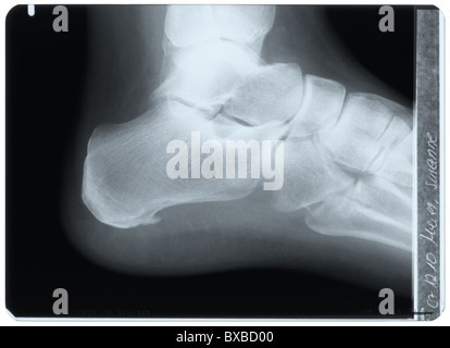 Plantarfasziitis mit Fersensporn (Kalkaneussporn): Laterales Fussröntgenbild mit Verkalkung. Lifestyle-Krankheit durch unsachgemäßes Schuhwerk, Überbeanspruchung. Stockfoto