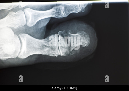 gebrochenen Zeh X-Ray Stockfoto