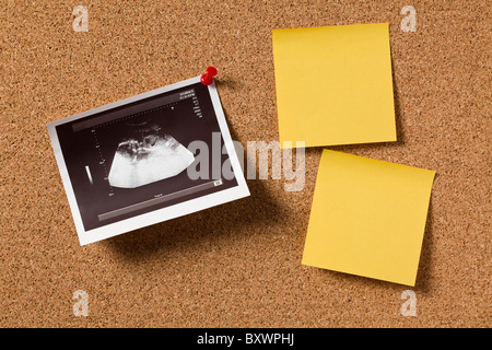 Das Ultraschall-Foto auf der Pinnwand Stockfoto