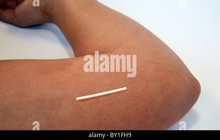 Ein Nexplanon-Progesteron Implantat sitzt auf einem jungen Womans Arm in der Nähe der Ellbogen in die Position, wo es eingefügt werden würde Stockfoto