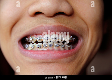 Junge mit Kieferorthopädie Zahnspange, 12 Jahre alt Stockfoto