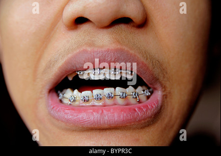 Junge mit Kieferorthopädie Zahnspange, 12 Jahre alt Stockfoto