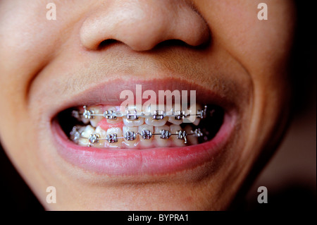 Junge mit Kieferorthopädie Zahnspange, 12 Jahre alt Stockfoto