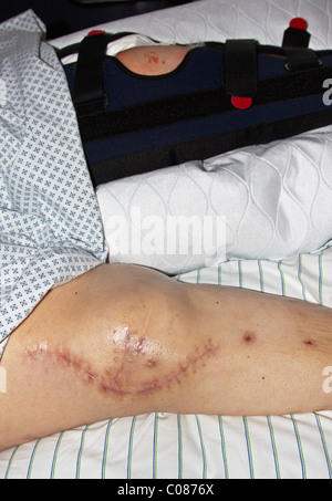 Frische Narbe auf das operierte Knie einer Frau nach dem Einsetzen von Implantaten nach einem schweren Verkehrsunfall Stockfoto