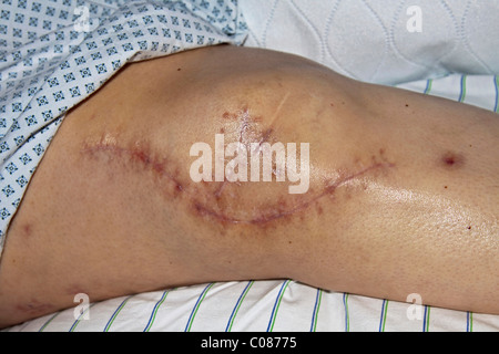 Frische Narbe auf eine operierte Knie nach dem Einsetzen von Implantaten nach einem schweren Verkehrsunfall Stockfoto