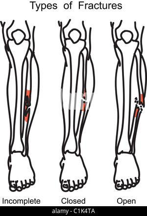 Arten von menschlichen Knochenbrüchen Abbildung Stockfoto