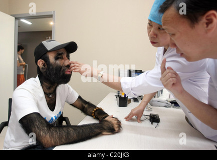 ES IST HAAR HEUTE, MORGEN... Der Mann der Welt haarigste Borsten als er bereitet sich auf Chirurgie - um seine Haut zu glätten. Yu Stockfoto