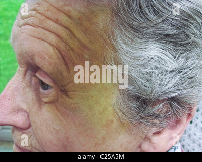 ältere Frau mit einem großen Bluterguss im Gesicht nach einem Sturz mit Stockfoto