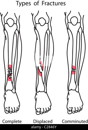 Arten von menschlichen Knochenbrüchen Abbildung Stockfoto