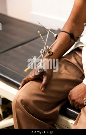 Amputierte Patienten mit einem Fixateur externe am Basveshwar Krankenhaus Sholapur Indien Stockfoto