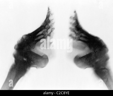 Röntgenaufnahme des gefesselten Füße, China um 1920 Stockfoto