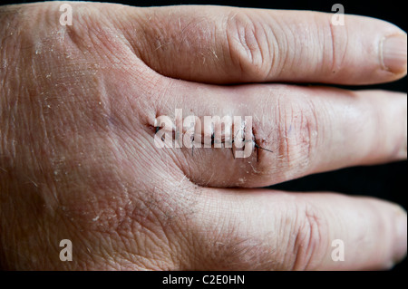 Sieben nicht auflösbare Nähte (Nähte) schließen einen chirurgischen Eingriff auf ein Mann Finger gewickelt Stockfoto