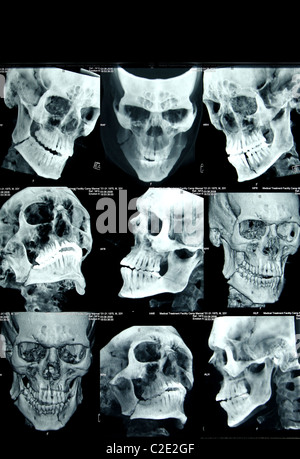 CT-Scans eines Kopfes, Mazar-e Sharif, Afghanistan Stockfoto