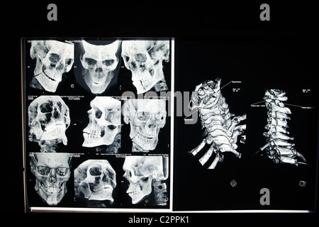 CT-Scans von Kopf und Wirbelsäule, Mazar-e Sharif, Afghanistan Stockfoto