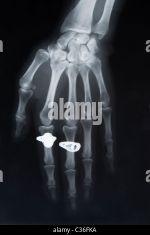 Vorderansicht des Röntgenbild der Hand mit zwei Ringen Stockfoto