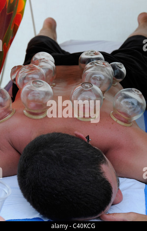 Saugnapf-Therapie Stockfoto