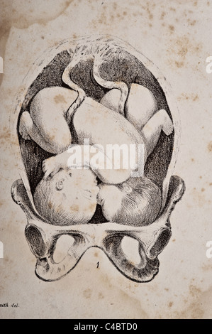 Illustration des menschlichen Zwillinge im Mutterleib copyright 1844 Stockfoto