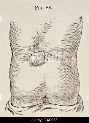 Antike medizinische Illustration mit Spina Bifida ca. 1881 Stockfoto