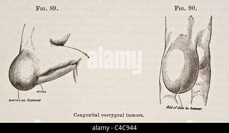 Antike medizinische Illustration der sakralen und Steißbein Tumoren ca. 1881 Stockfoto