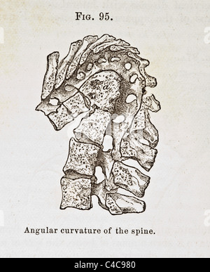 Antike medizinische Illustration, Darstellung der Krümmung der Wirbelsäule Stockfoto